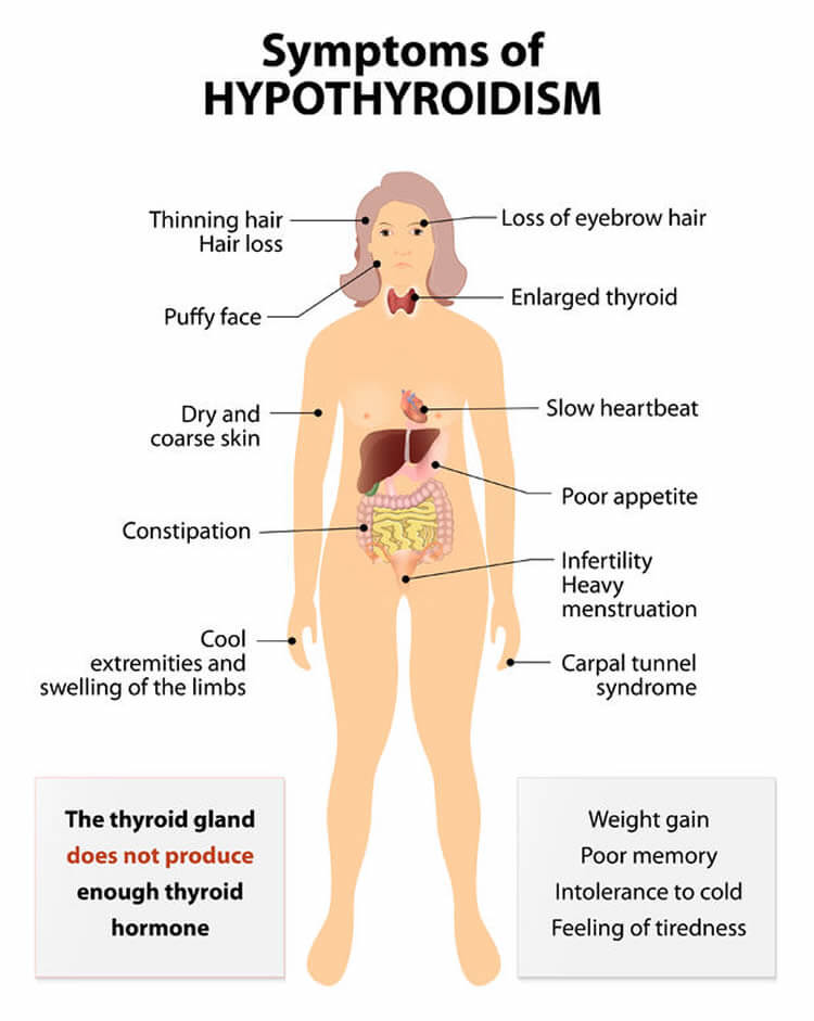 Tucson Hypothyroidism